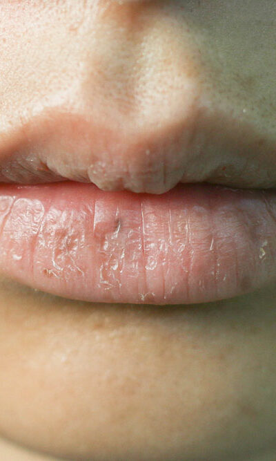 4 common mistakes that make one’s lips dry and damaged
